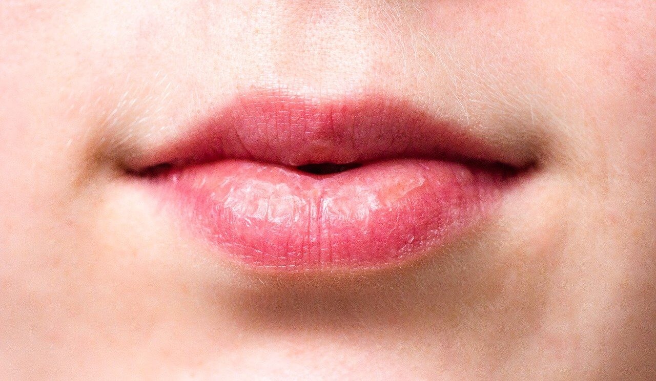 Wrinkles Above the Lips: The Best Treatments & Prevention